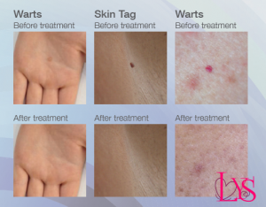 Wart Removal and Skin Tag Removal Nottingham and Newark - MedSkin Clinic
