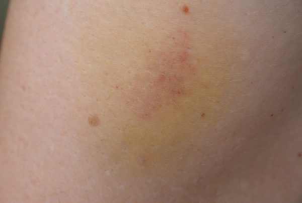 Port wine stains and how to treat them -