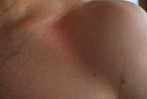 3 Common Misconceptions about Skin Needling -