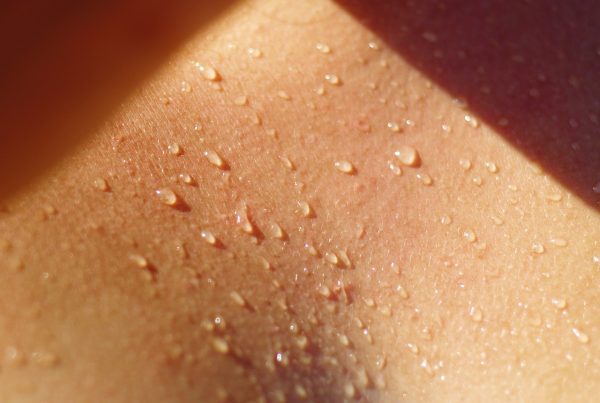 Surviving the summer with hyperhidrosis -