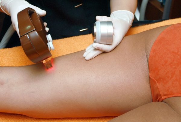 Benefits of IPL Hair Removal Treatments - MedSkin Clinic