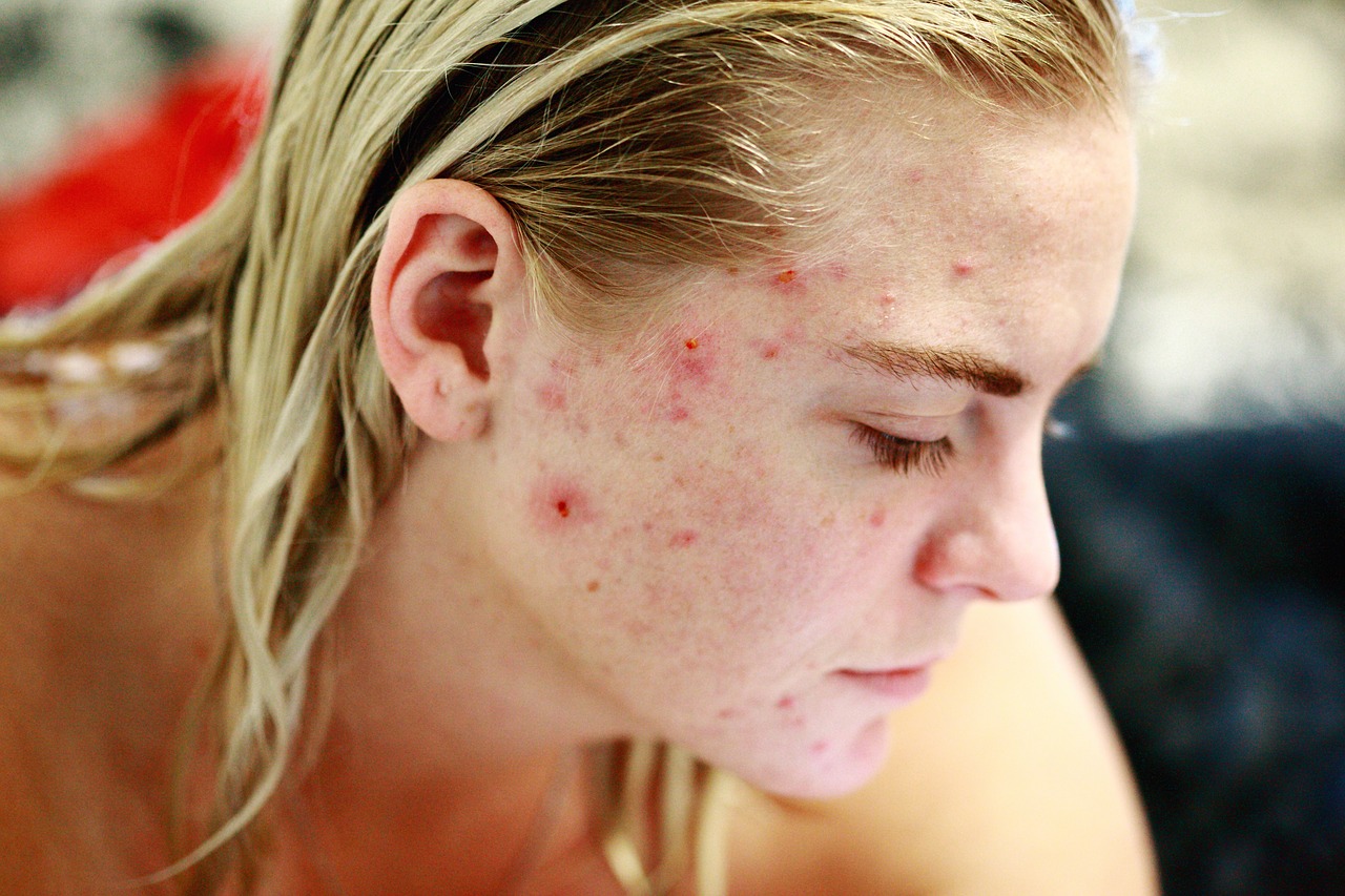 Microneedling for Acne Scars is your Solution – NOT Make-Up