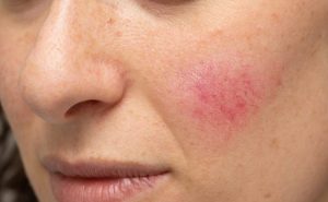 3 non-aesthetic reasons for treating your rosacea -