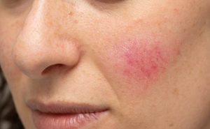 3 non-aesthetic reasons for treating your rosacea - MedSkin Clinic