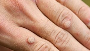 A wart can affect your professional life - so have yours removed! - MedSkin Clinic