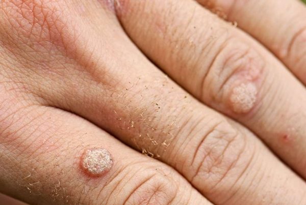 Wart Skin Tag Removal Nottingham Beeston West Bridgford Chesterfield MEDSKIN
