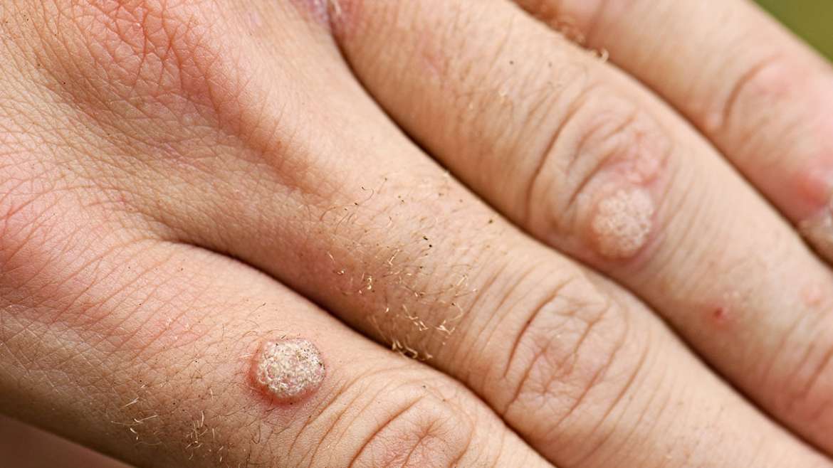 A wart can affect your professional life – so have yours removed!