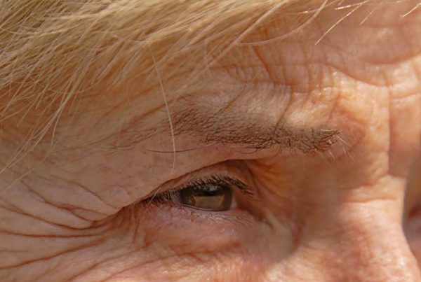 The problem with having excessive crow’s feet in your 20s - Medskin Clinic