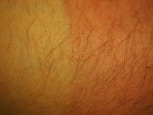 Fed up of your baby hairs? Remove them with IPL treatment -