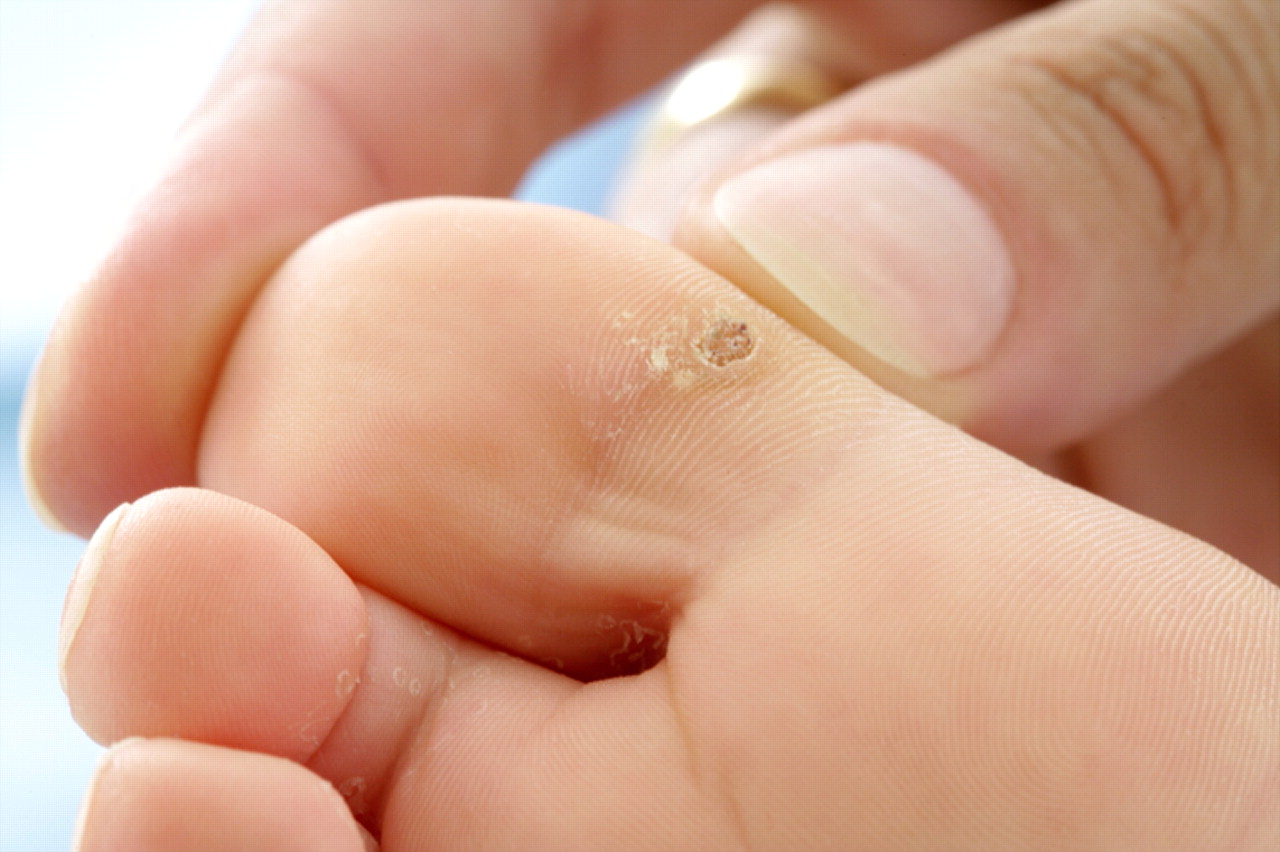 Three habits that might have caused you to develop your wart