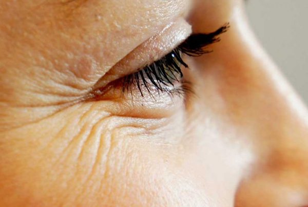 Anti Wrinkle Botox tm Brand Eye Lift Surgical Treatments Beeston West Bridgford Nottingham Chesterfield