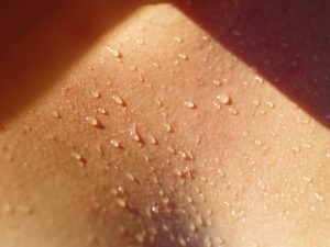 Hyperhidrosis - Sweating and Perspiration Treatments UK Nottingham and Chesterfield - MedSkin Clinic