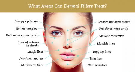 Dermal Fillers Nottingham Newark Chesterfield