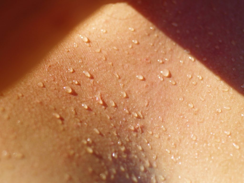 The secret cost of hyperhidrosis -