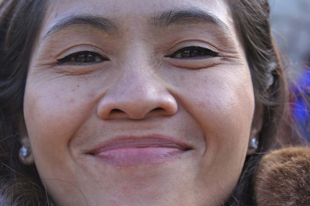 Crow's feet around the eyes? Here are your treatment options -