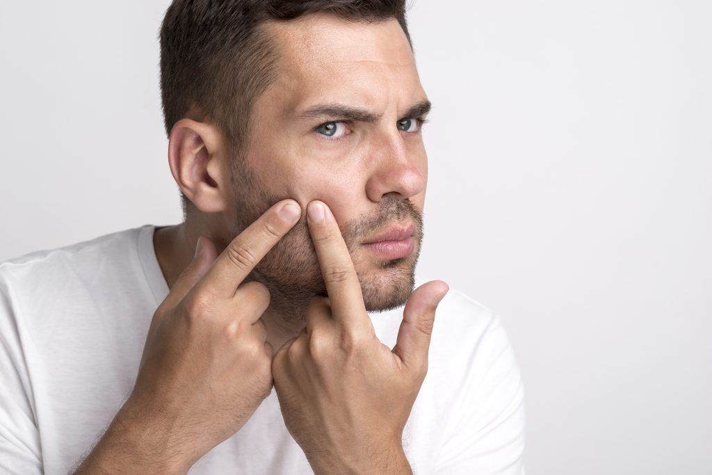 How to rid yourself of adult acne -
