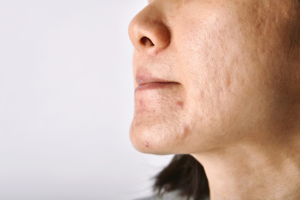 Rosacea Acne Treatment Nottingham Dermal Fillers Beeston West_Bridgford microdermabrasion skin Tag Removal Wart Cheek Fillers Chesterfield Lincoln Leicester Beauty Skin Dermatology Treatments
