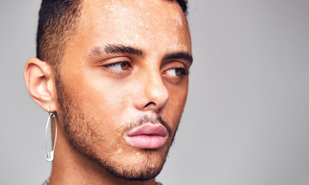 What causes pigmentation? - thoughtful young man with skin pigmentation disord UJ8WMLQ What causes pigmentation? -