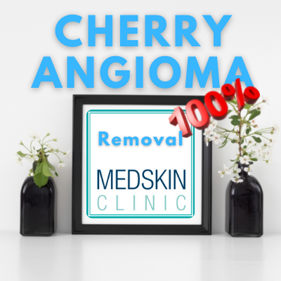 Home Remedies for Cherry Angiomas vs Cryotherapy Private Clinic