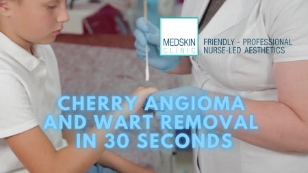 Cherry Angioma Removal Treatment 60 Seconds Freezing Nurse-led Cryotherapy Permanent Nottingham Derby Chesterfield Medskin Private Clinics