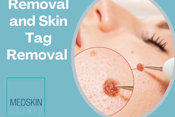 Wart Removal and Skin Tag Removal Nottingham and Newark - MedSkin Clinic