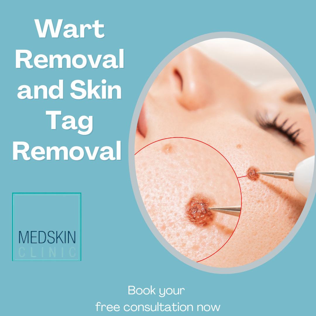 Wart Removal and Skin Tag Removal Nottingham and Newark
